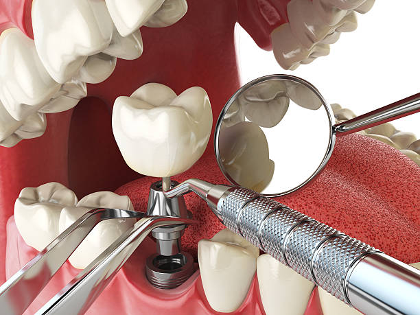 Best Emergency Root Canal Treatment in Manly, IA